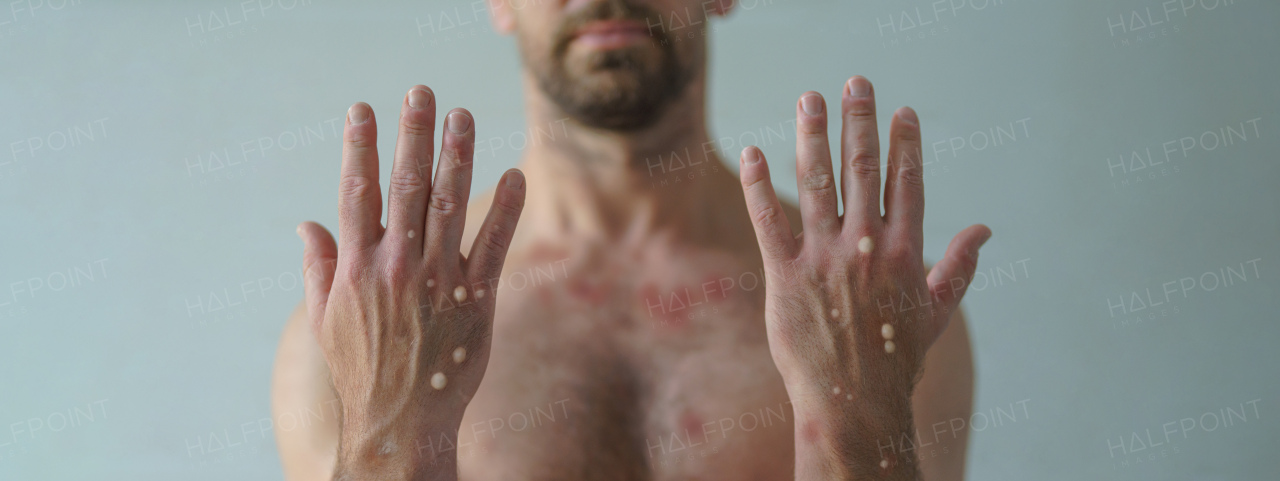 A male hands affected by blistering rash because of monkeypox or other viral infection on white background