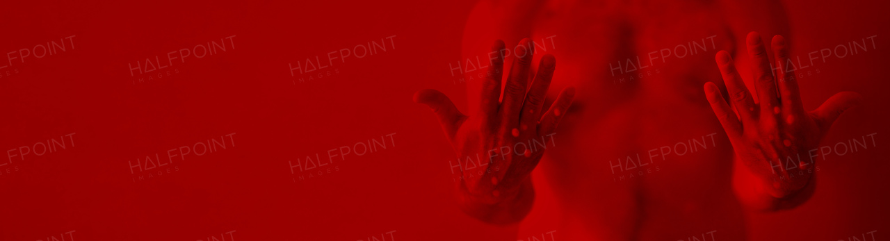 A male hands affected by blistering rash because of monkeypox infection on red background